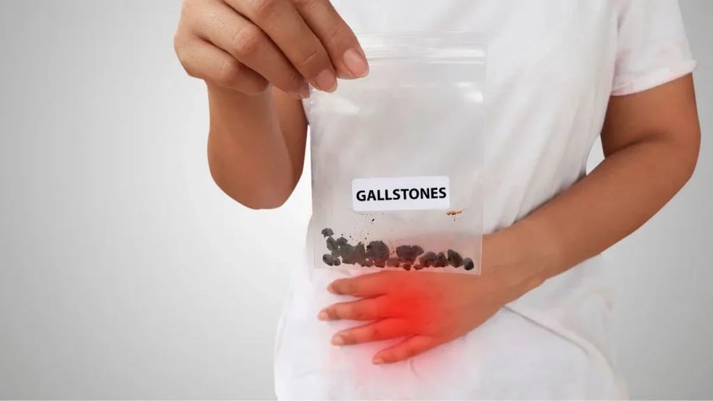 gallstones