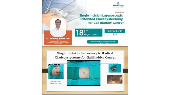 Talk on Single Incision Laparoscopic Radical Cholecystectomy for Gallbladder Cancer (with operative video of a case done recently)